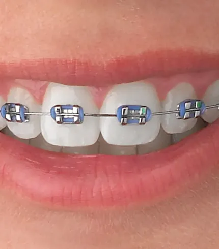Metal Braket